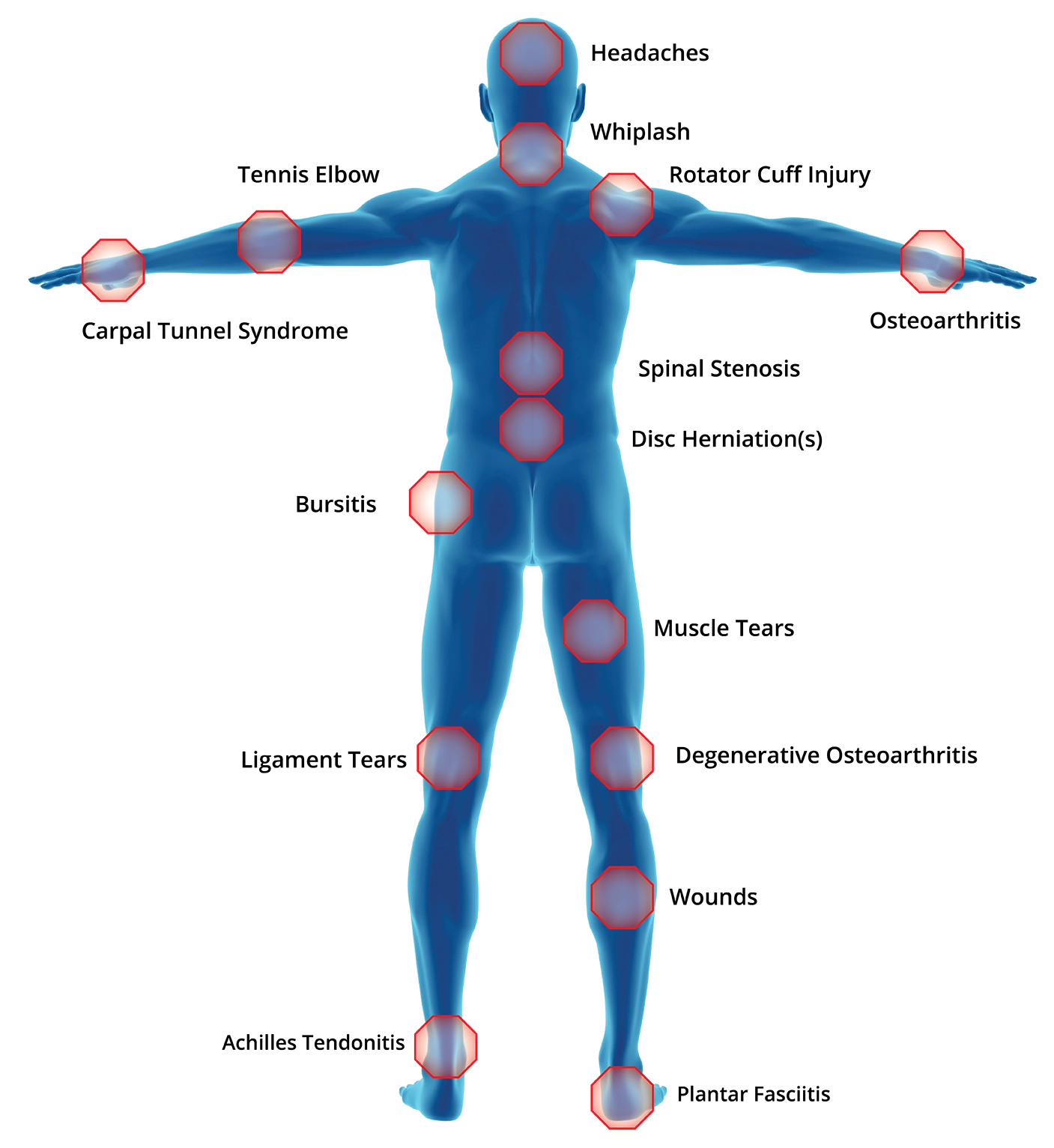 conditions treated at BIOFLEX Laser Therapy for pain relief including arthritis, tendonitis, and muscle injuries